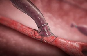 VasQ external support comparative US study results presented at VASA 2022 VasQ