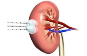 For some small kidney cancers, freezing is more effective than heat treatment