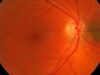 Retinal age gap associated with ESKD says new study examining UK Biobank data