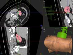 First patient treated with HistoSonics Edison histotripsy system