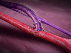 Physicians around the world agree: VasQ is revolutionising AVF outcomes