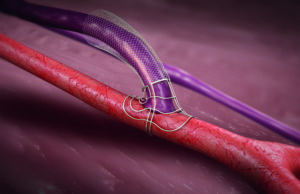 Physicians around the world agree: VasQ is revolutionising AVF outcomes