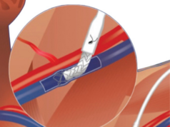 EndoForce Endovascular Anastomotic Connector: A novel approach for AVG creation