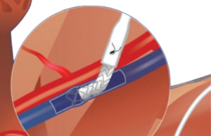 EndoForce Endovascular Anastomotic Connector: A novel approach for AVG creation