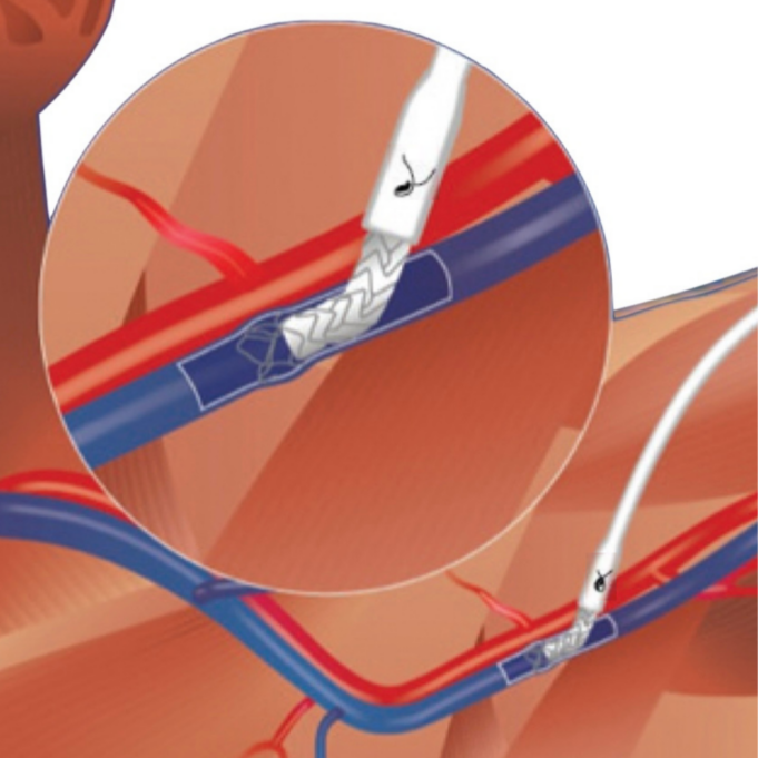 EndoForce Endovascular Anastomotic Connector: A novel approach for AVG creation