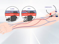 XS Innovations raises seed investment of EUR 1.1 million to accelerate development of vascular access device “the Dynamic AVF”