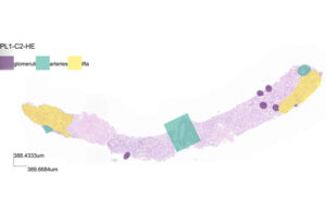 Research from the National Physical Laboratory and the University of Cambridge boosts long-term kidney transplant success rates