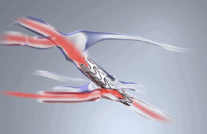 Early feasibility study for Velocity pAVF system now fully enrolled