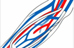 Spiral Laminar Flow AV graft portfolio gains US FDA clearance