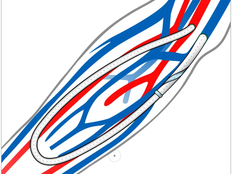 Spiral Laminar Flow AV graft portfolio gains US FDA clearance - Renal ...