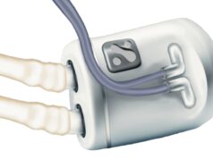 US FDA grants breakthrough designation for implantable dialysis system